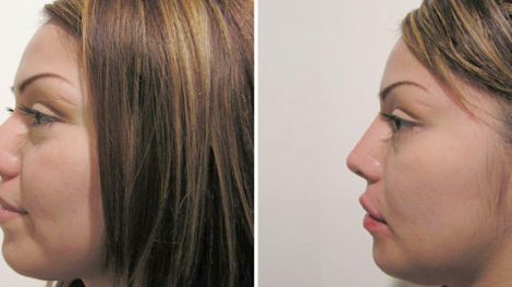 4-things-you-didnt-know-about-rhinoplasty
