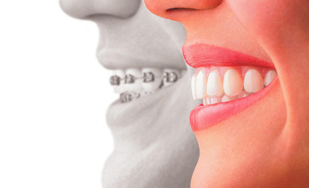 A Basic Guide to Invisalign