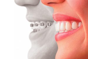 A Basic Guide to Invisalign