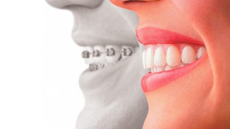 A Basic Guide to Invisalign