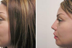 4-things-you-didnt-know-about-rhinoplasty